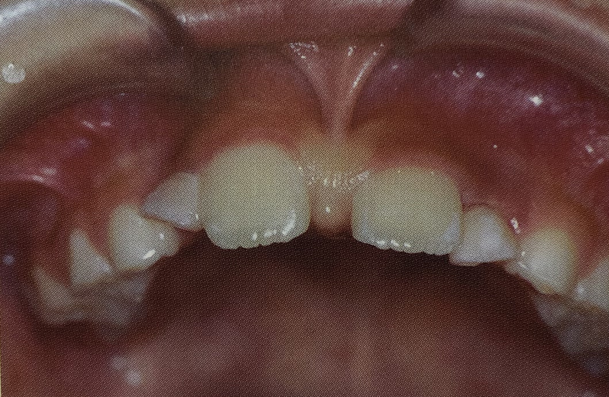 乳歯から永久歯への生えかわりの時期によく見られること