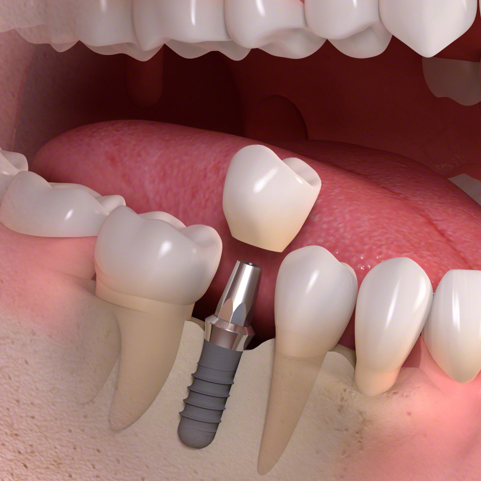 インプラント治療と従来の治療法（ブリッジ・入れ歯）との比較