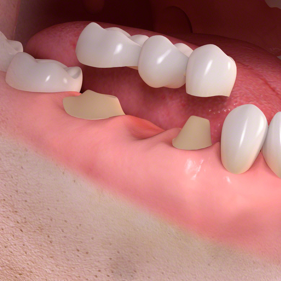 インプラント治療と従来の治療法（ブリッジ・入れ歯）との比較
