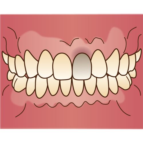 歯の内因性の着色
